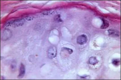 De quelle couleur l'exanthème érythémateux apparaissant vers le quatrième jour de la maladie est-il ?