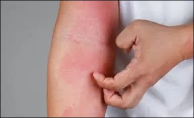 Cette maladie cutanée provoquant des démangeaisons, c'est de...