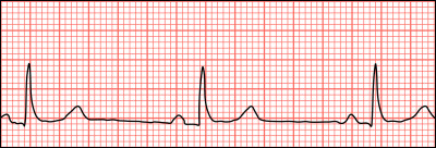 Quel nom de maladie signifie en grec "battement lent du cur" ?