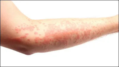 Quel est le genre du nom urticaire, dermatose inflammatoire ?