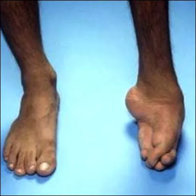 Quelle reine des Francs devrait son surnom au fait quelle avait un pied bot ?