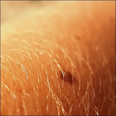 Comment appelle-t-on la partie visible d'une lésion du derme après la réparation du tissu, à la suite d'une blessure ?