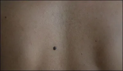 Origine de démangeaison, c'est l'...