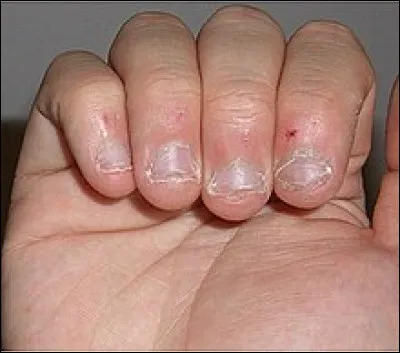 L'acte de se ronger les ongles, en général des mains, et parfois des pieds s'appelle...