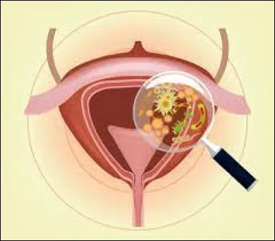 Inflammation de la vessie :