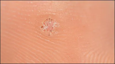 Quelle tumeur cutanée bénigne a pour origine l'infection de la peau par le papillomavirus humain ?