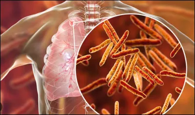 La tuberculose est-elle une maladie du passé ?