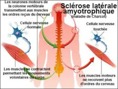 Lequel de ces surnoms est parfois donné à la SLA ?