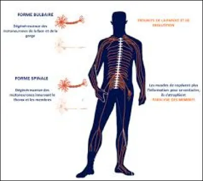 La SLA peut-elle affecter la respiration et la déglutition ?