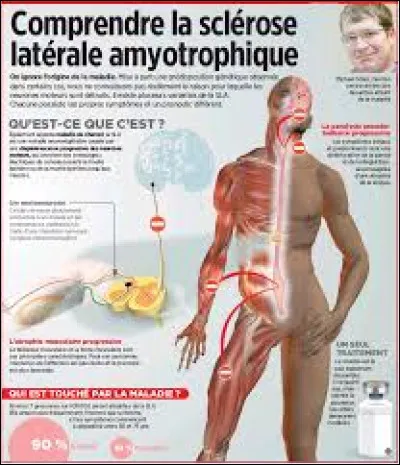 A quel âge Stephen Hawking est-il décédé, après avoir vécu plus de 50 ans avec la SLA ?