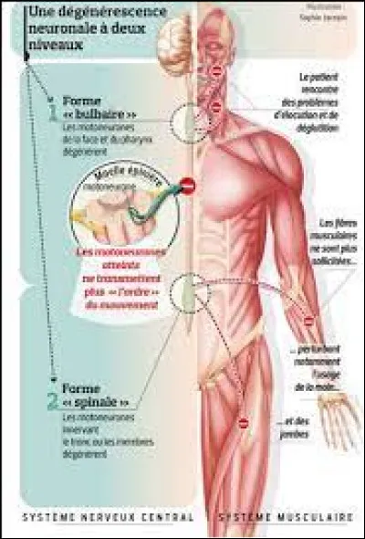 Quelle est l'espérance de vie moyenne après le diagnostic de la SLA ?