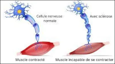 Laquelle de ces propositions est une complication fréquente associée à la SLA ?