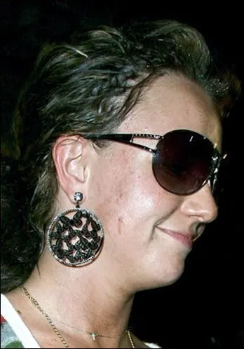 Aprs une sance de bronzage, elle a chop des boutons et quelques plaques sur le visage, qui est-ce ?