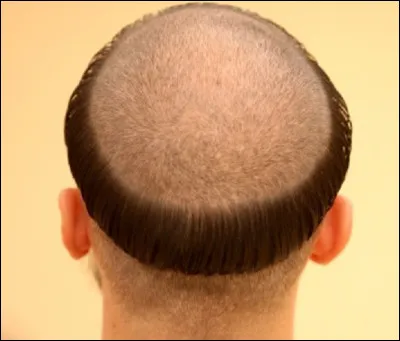 Quel est le nom savant de la tonsure de certains moines ?