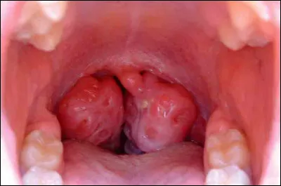 Quelle est la bonne orthographe des deux organes situés sur la paroi latérale du larynx ?