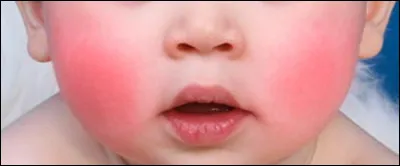 Avec le soleil, mes amis ont les joues (framboise) alors que les miennes sont (abricot).