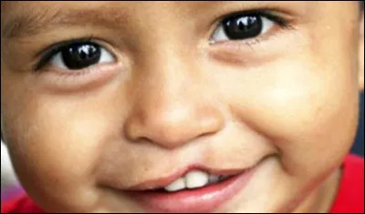 Quel nom porte cette malformation de la lèvre ?