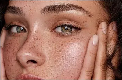 Quel est le nom scientifique des taches de rousseur ?