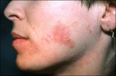 Quel est le nom scientifique de la tache de vin ?