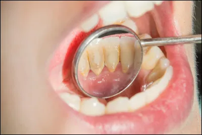 De quoi la plaque dentaire est-elle constituée principalement ?