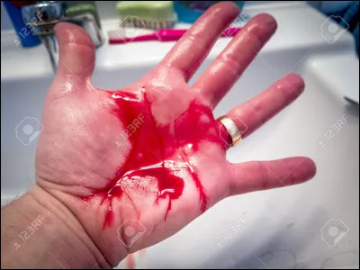 Quand tu t'ouvres le bras et qu'il y a du sang, que fais-tu ?