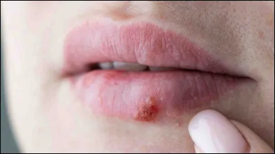 Quel est le nom scientifique du bouton de fièvre ?