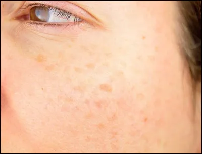 Quel est le nom (dérivé du latin ''lentille'') de ces petites taches de la peau, pigmentées et plus ou moins rondes ?