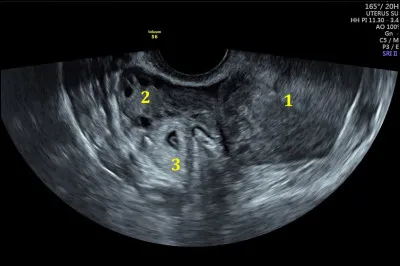 La mythologie grecque la voit condamnée par Héra à ne plus parler, seulement la fin des mots qu'elle entend, qui est elle ?