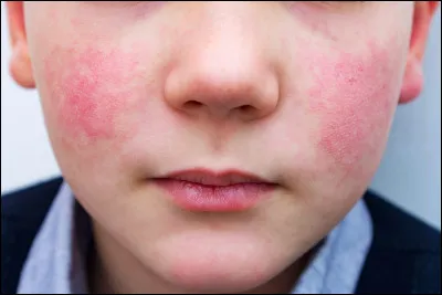 Quelle est la couleur de tes joues quand il fait froid ?