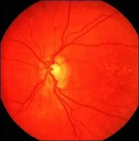 Quelle affection la dgnrescence maculaire entrane-t-elle ?