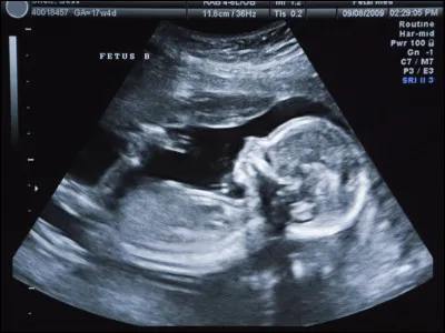 Où ne peut pas s'implanter un bébé, dans le cadre d'une grossesse extra-utérine ?