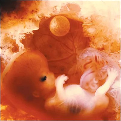 Qu'est-ce qu'un ischiopagus ?