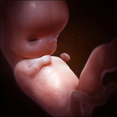 Comment se traduit le syndrome transfuseur-transfusé ?