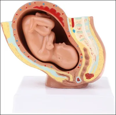 Qu'est-ce qu'un lithopédion ?