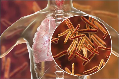 Pourriez-vous me dire de quoi est mort Louis Braille ?