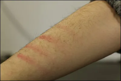 Es-ce que vous vous blessez volontairement ?