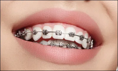 Celui-ci s'occupe de l'alignement des dents :