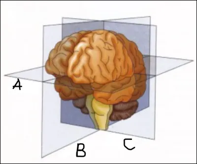 Complétez le schéma : ''les différentes coupes du cerveau sont...