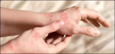 Quelle est la maladie des coiffeurs la plus fr&eacute;quente ?