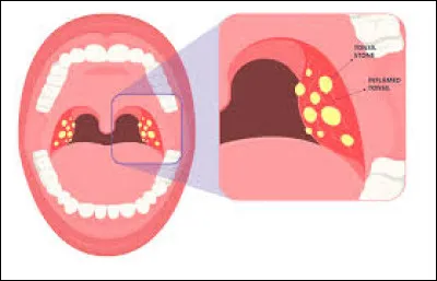 La semaine dernière, je me suis fait opérer des ... .