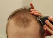 Test Quelle calvitie l'avenir vous rserve-t-il ?