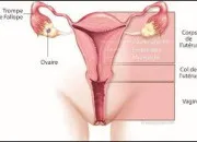 Quiz Prvention : que savez-vous du cancer de l'endomtre ?