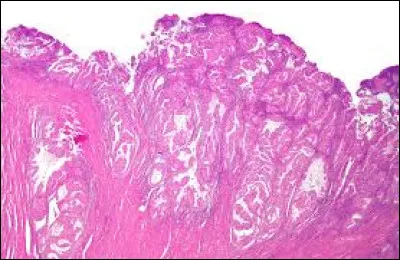Quelle est la survie à ce cancer dans les 5 ans s'il est de stade I ?