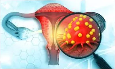 A quelle prise en charge de vos traitements avez-vous droit sous ALD ?