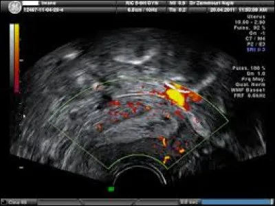Dans lequel de ces cas votre consultation d'un psychologue ne sera-t-elle pas prise en charge par l'Assurance maladie au cours de votre traitement du cancer de l'endomètre ?