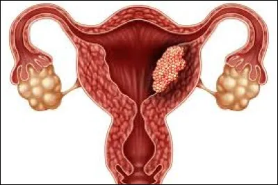 Généralement, par le biais de quel test diagnostique-t-on ce cancer ?