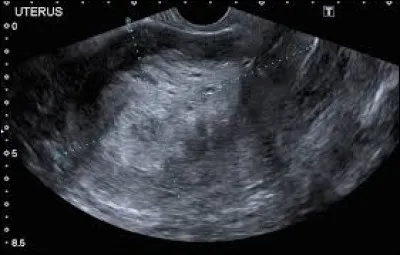 A quelle place arrive-t-il dans les cancers gynécologiques les plus courants ?