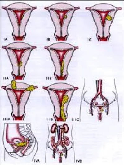 Quel est le facteur de risque principal de ce cancer ?