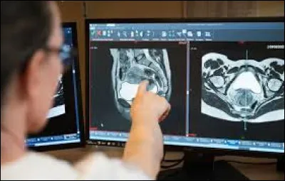 Quelle partie du corps est atteinte lorsque ce cancer atteint le stade II ?