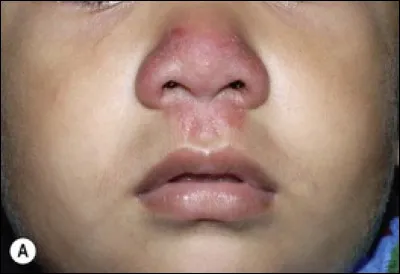 Quel est le nom scientifique du ''doigt de l'ange'', fossette située au milieu de la lèvre supérieure des humains ?